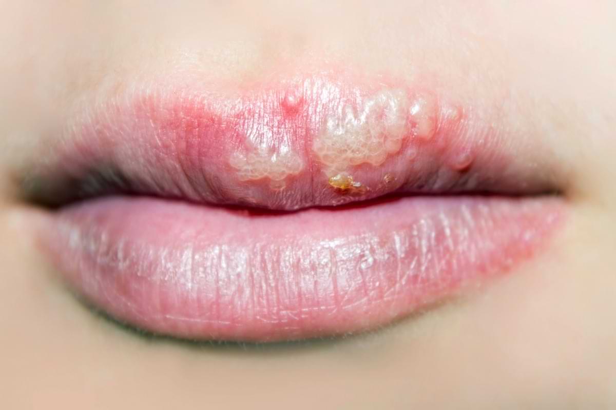 Antiherpes medication use linked to 17 reduced risk of Alzheimers.jpg