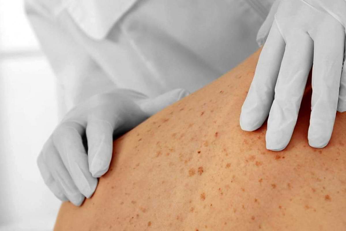 Die HautkrebsFrüherkennung soll verändert werden.jpeg