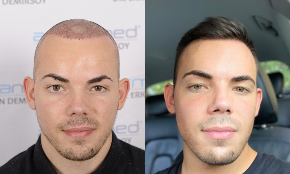 haartransplantation vorher nacher türkei.jpg
