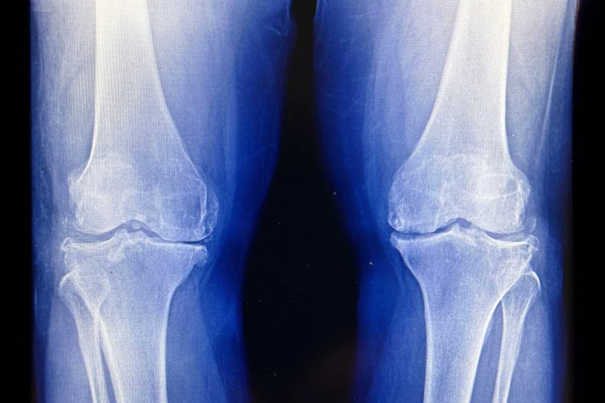 Lowdose radiation relieves knee osteoarthritis pain improves function.jpg