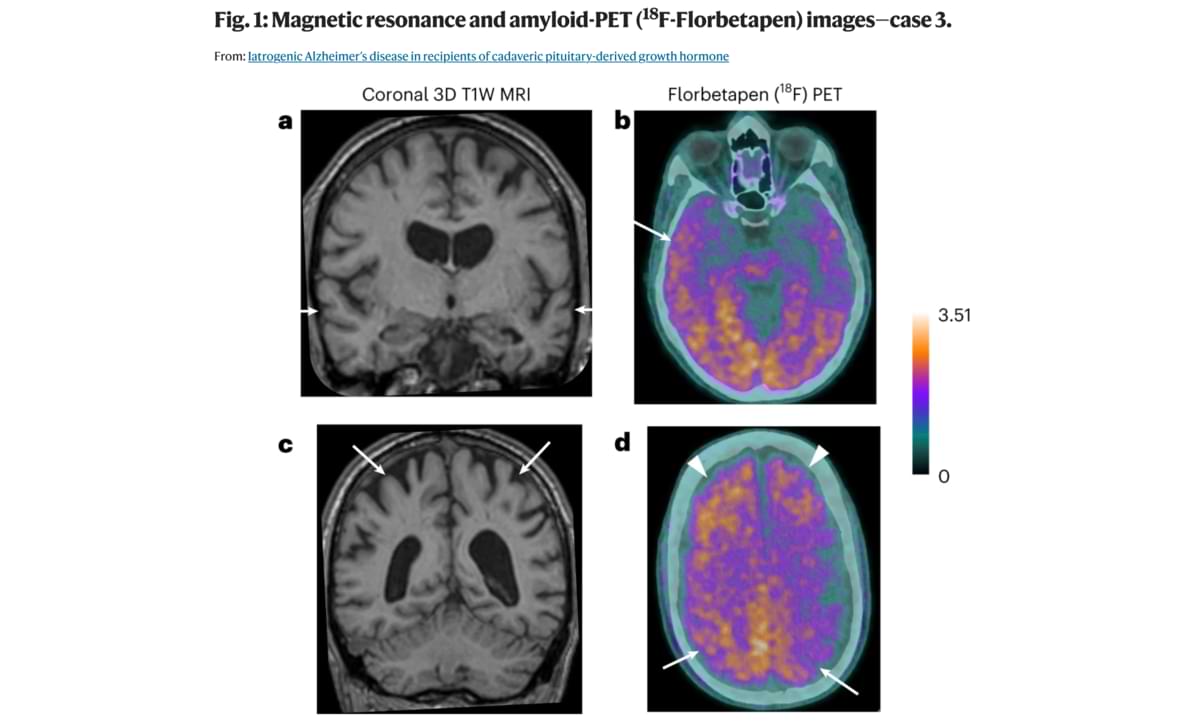 Magnetic resonance and amyloid-PET (18F-Florbetapen).jpg