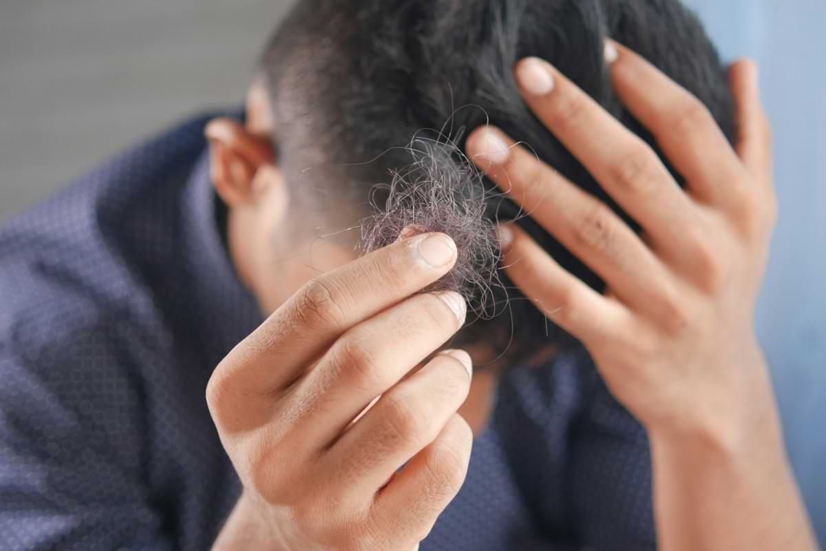 Natural sweetener found to turbocharge baldness treatment.jpg