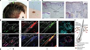 Hyperactivation of hair growth in nevus skin. Nature.jpg