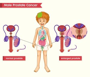 prostata-krebs-mann-schaubild-anatomie.jpg