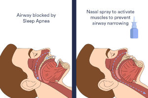 Nasal-spray-for-sleep-apnea-04blog-size-1024x683.jpg