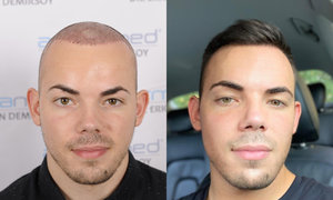 haartransplantation vorher nacher türkei.jpg