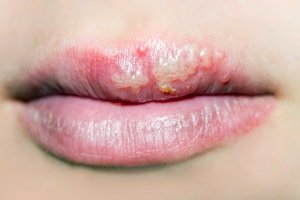 Antiherpes medication use linked to 17 reduced risk of Alzheimers.jpg