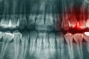 Exercise omega3 combo reduces severity of chronic tooth root infection.jpg