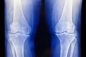 Lowdose radiation relieves knee osteoarthritis pain improves function.jpg